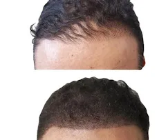 Before and after frontal hairline restoration