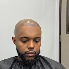Finished scalp micropigmentation hairline result