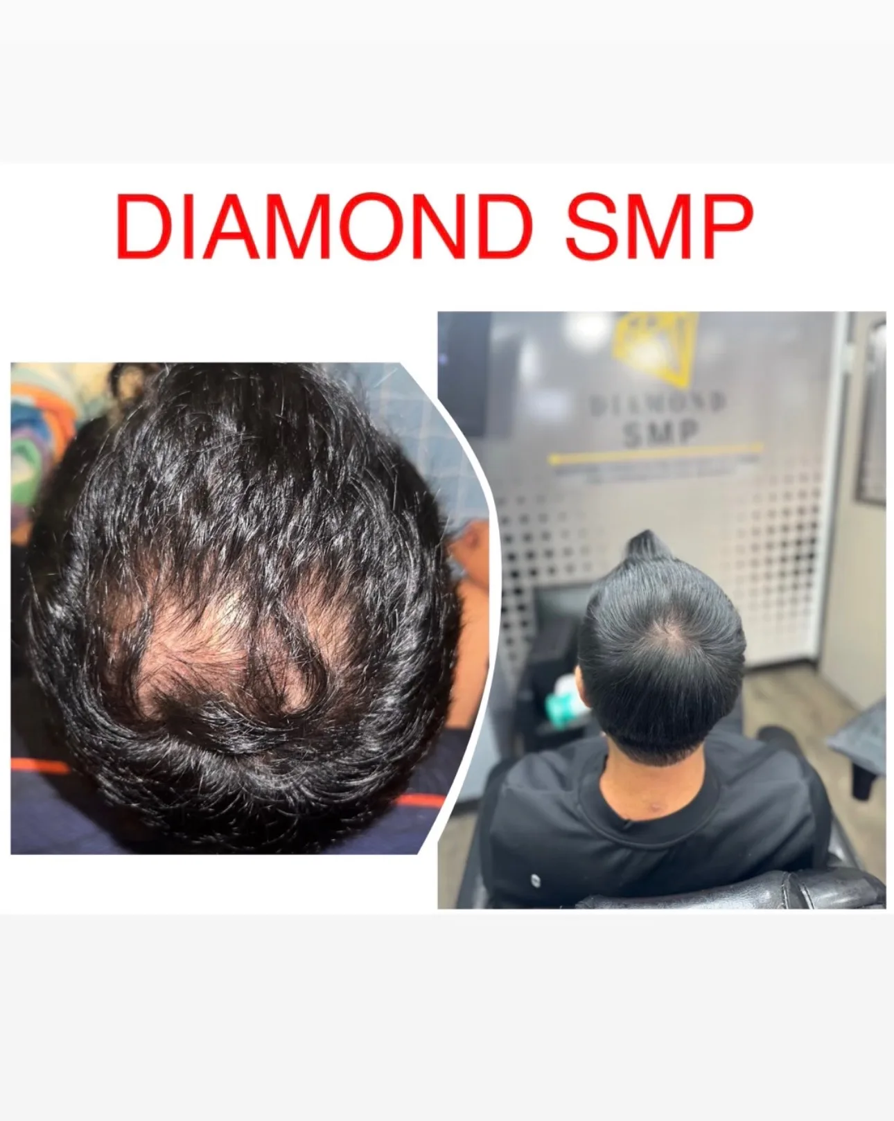 Before and after crown restoration result