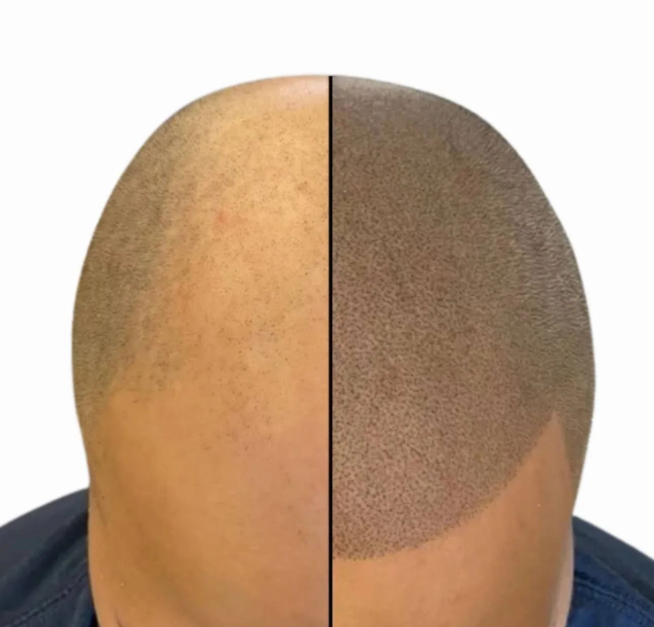 Split view showing scalp density before and after treatment