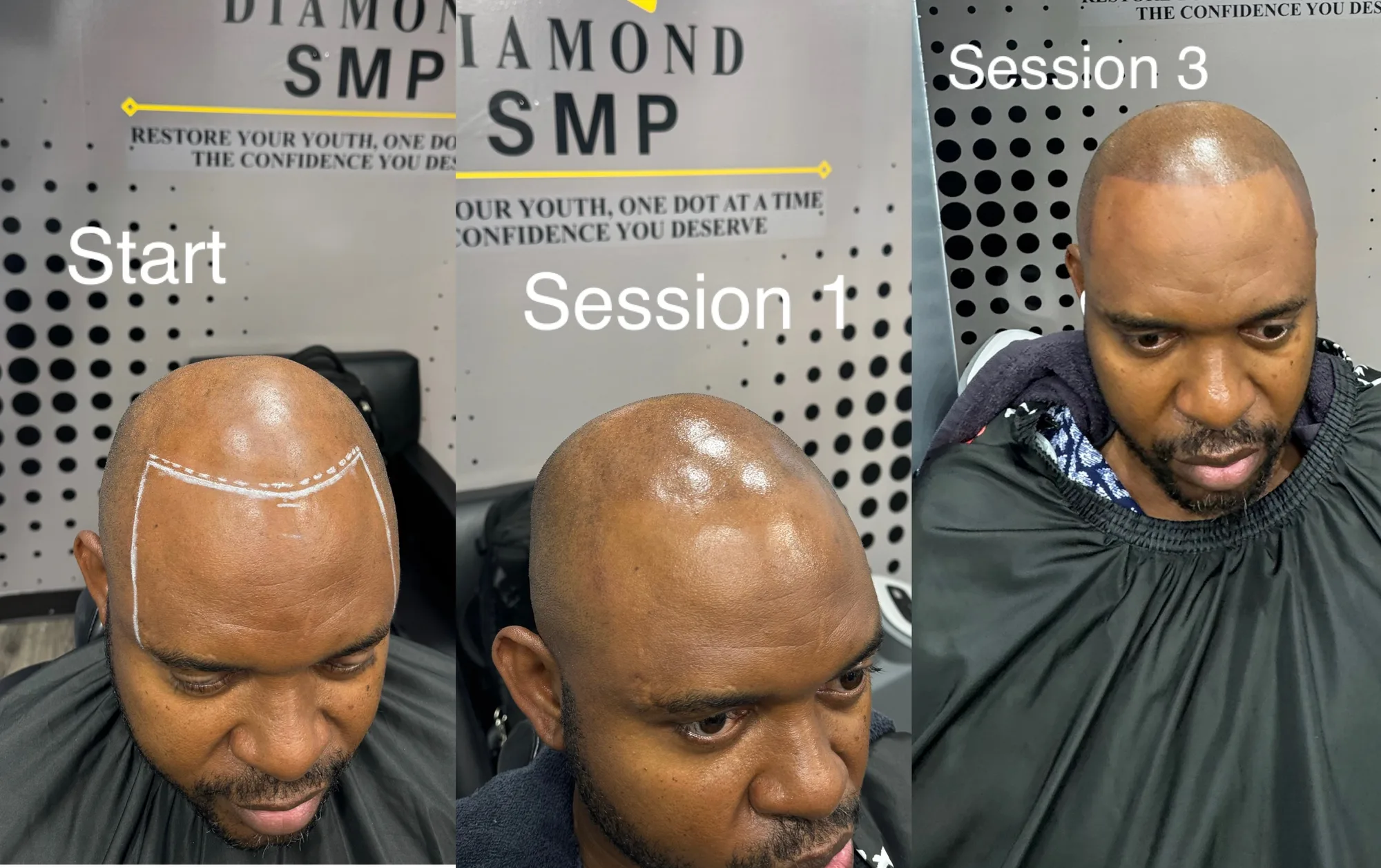 Three-panel scalp micropigmentation progression from start through session three