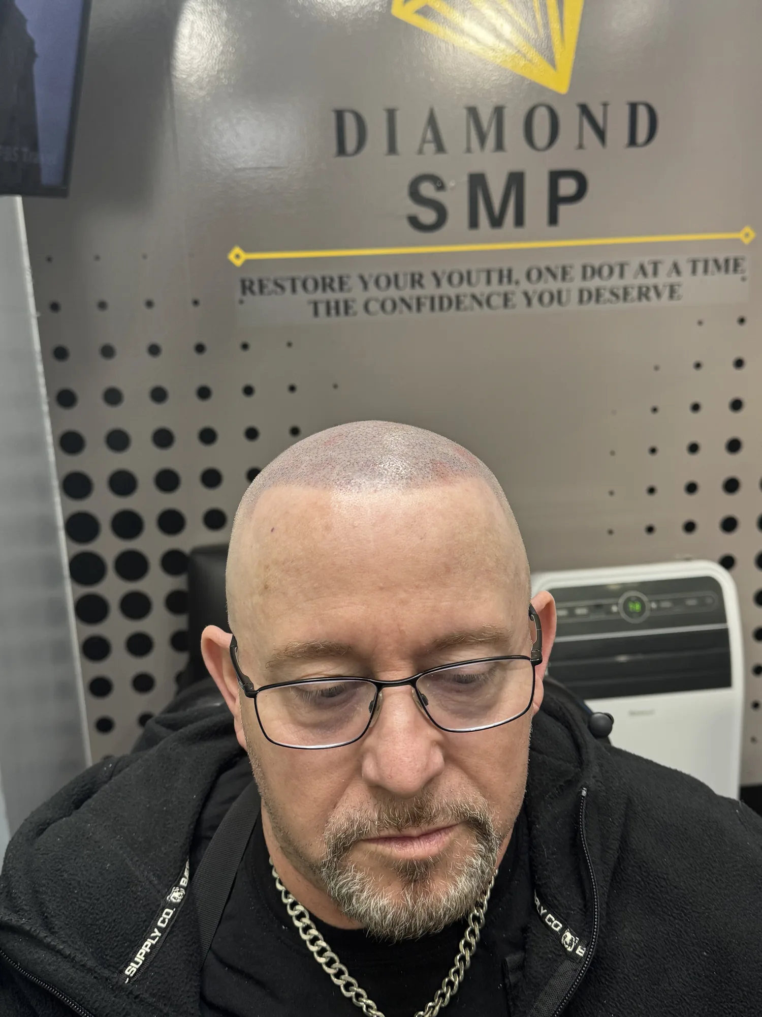 Close-up post-session scalp micropigmentation treatment detail
