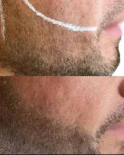 Before and after beard density enhancement