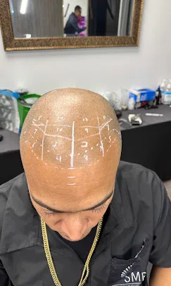 Scalp mapping guide lines before treatment