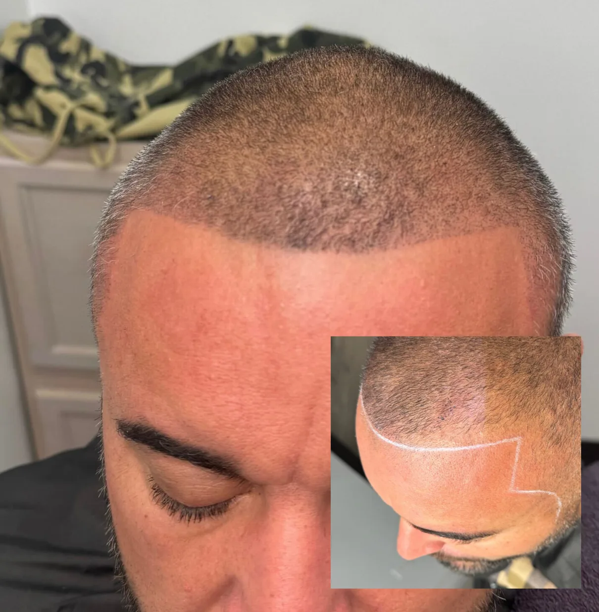 Hairline Detail