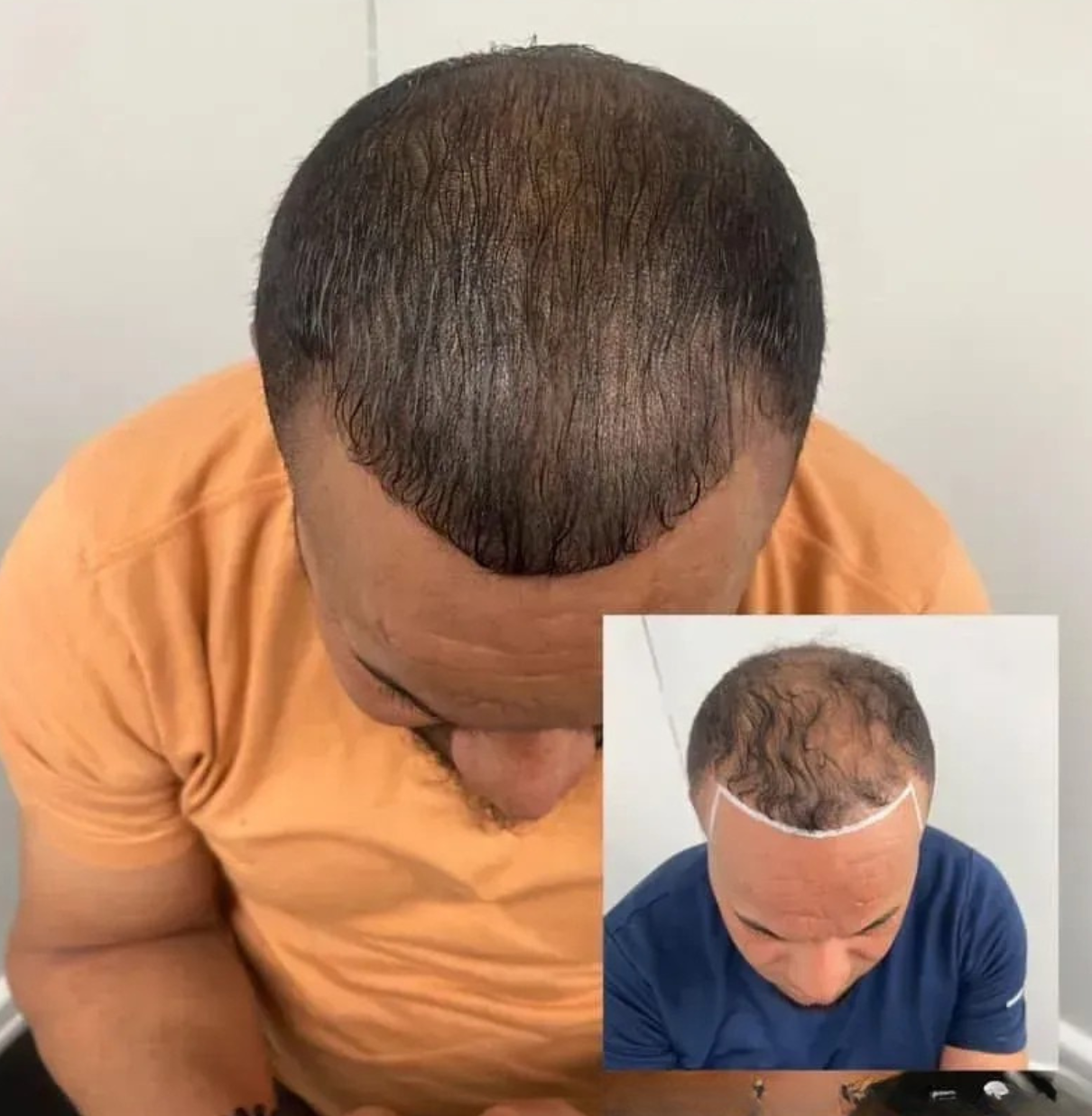 Density enhancement result