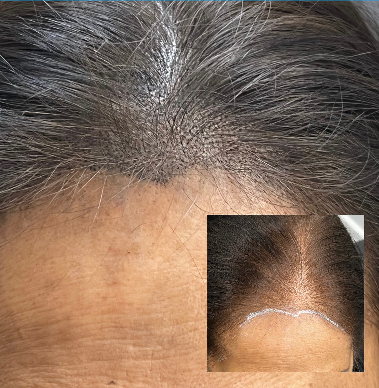 Scar camouflage result